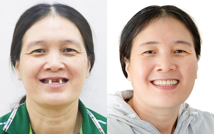 20 năm mất răng và hành trình tìm lại hạnh phúc nhờ trồng răng Implant