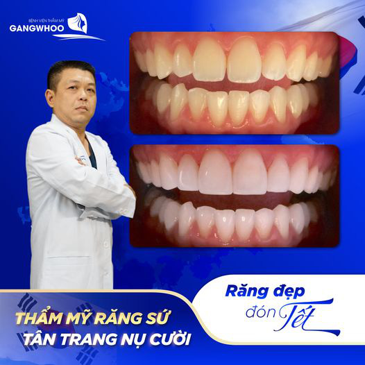 Bệnh viện thẩm mỹ Gangwhoo bọc răng sứ giúp loại bỏ mọi khuyết điểm về răng - Ảnh 1.
