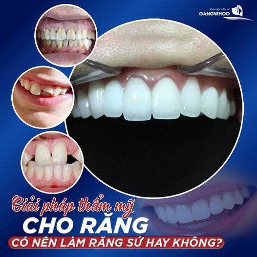 Bệnh viện thẩm mỹ Gangwhoo bọc răng sứ giúp loại bỏ mọi khuyết điểm về răng - Ảnh 2.