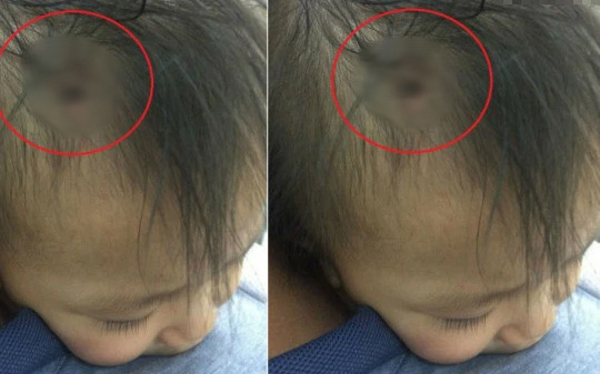 Sự thật về bức ảnh chiếc đinh găm vào đầu cháu bé được cho là nạn nhân nghi án bạo hành ở Hà Nội