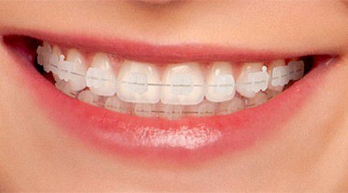 Niềng răng cũng có nhiều loại nhưng bạn chọn loại nào để nhanh chóng có hàm răng đều như hạt bắp? - Ảnh 4.