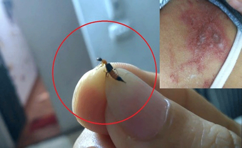 Nhiều người bị viêm da do tiếp xúc với kiến ba khoang: Phân biệt kiến ba khoang đốt và bệnh zona - Ảnh 2.