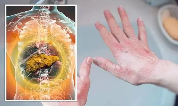 Dấu hiệu ở lòng bàn tay cảnh báo bệnh gan nhiễm mỡ tăng nặng hoặc 6 bệnh nguy hiểm khác - Ảnh 2.