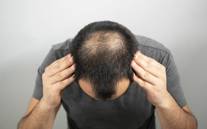 Thuốc trị rụng tóc cho nam giới Finasteride có gây yếu sinh lý hay không?