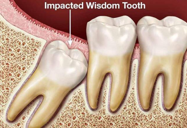 Răng khôn mọc ngu: Câu chuyện truyền kiếp về chiếc răng khôn và cách xử lý đúng đắn nhất - Ảnh 5.