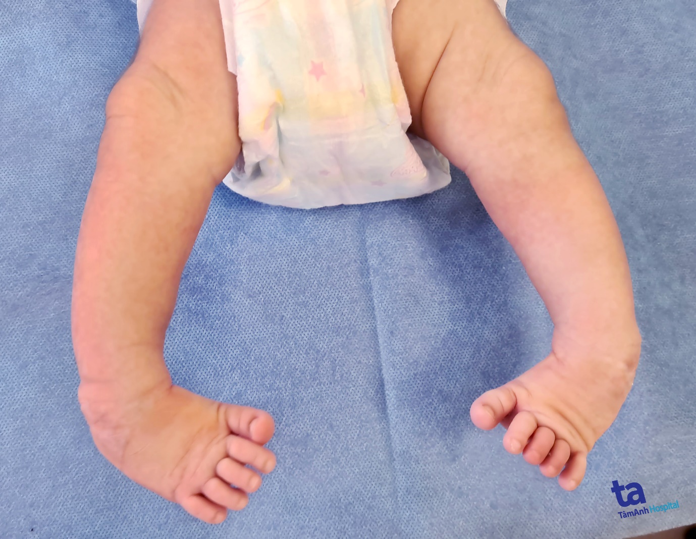 Trị liệu chân khoèo bẩm sinh cho bé sơ sinh - Ảnh 2.