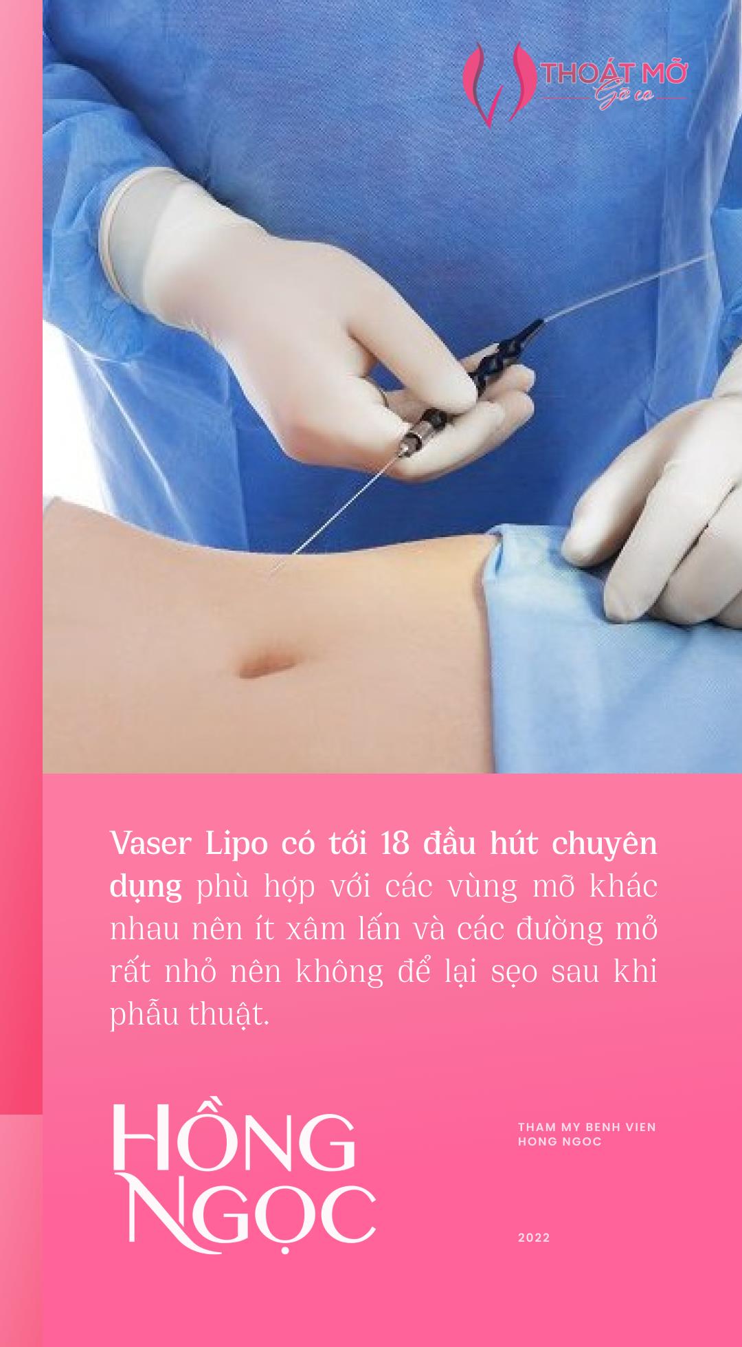 Công nghệ hút mỡ Vaser Lipo: Những sự thật mà không phải ai cũng biết?! - Ảnh 4.