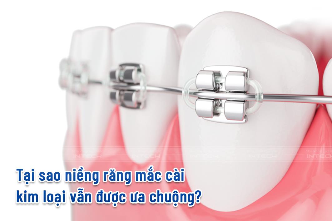 Lý do gì khiến niềng răng mắc cài kim loại vẫn được nhiều người ưa chuộng? - Ảnh 2.