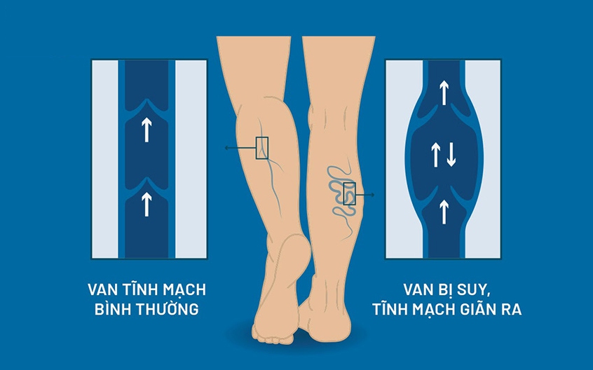 TPBVSK Hộ Mạch An - Giải pháp hỗ trợ người bị suy giãn tĩnh mạch