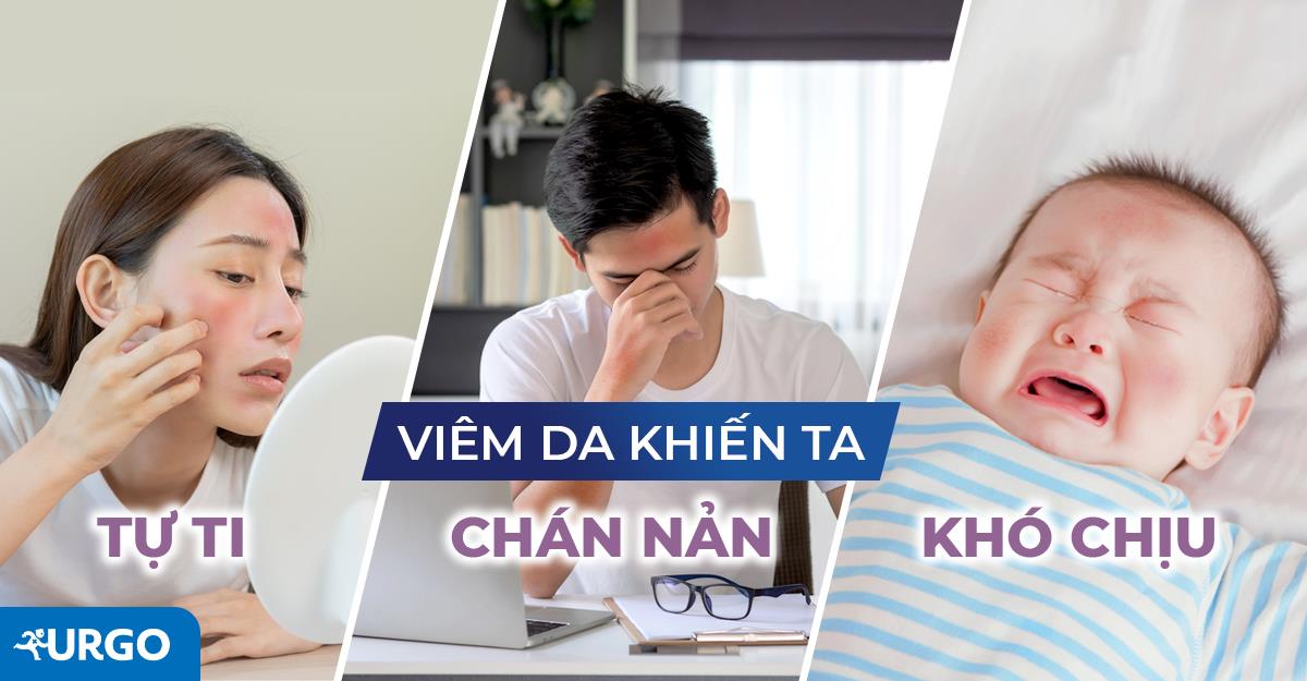 Giải pháp làm dịu sự khó chịu của làn da khi bị viêm da cơ địa - Ảnh 2.