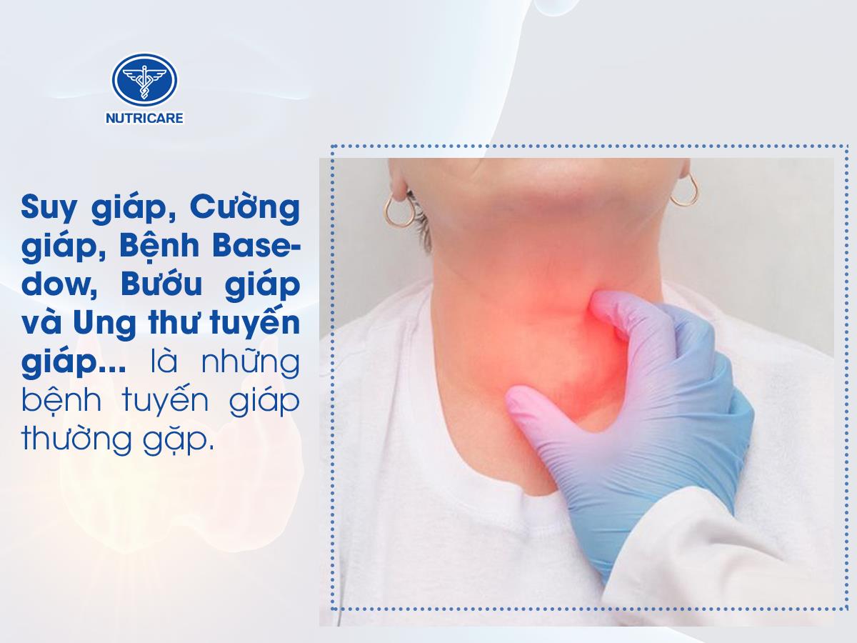 Người bệnh tuyến giáp nên kiêng ăn gì và bổ sung thực đơn thế nào cho tốt? - Ảnh 2.