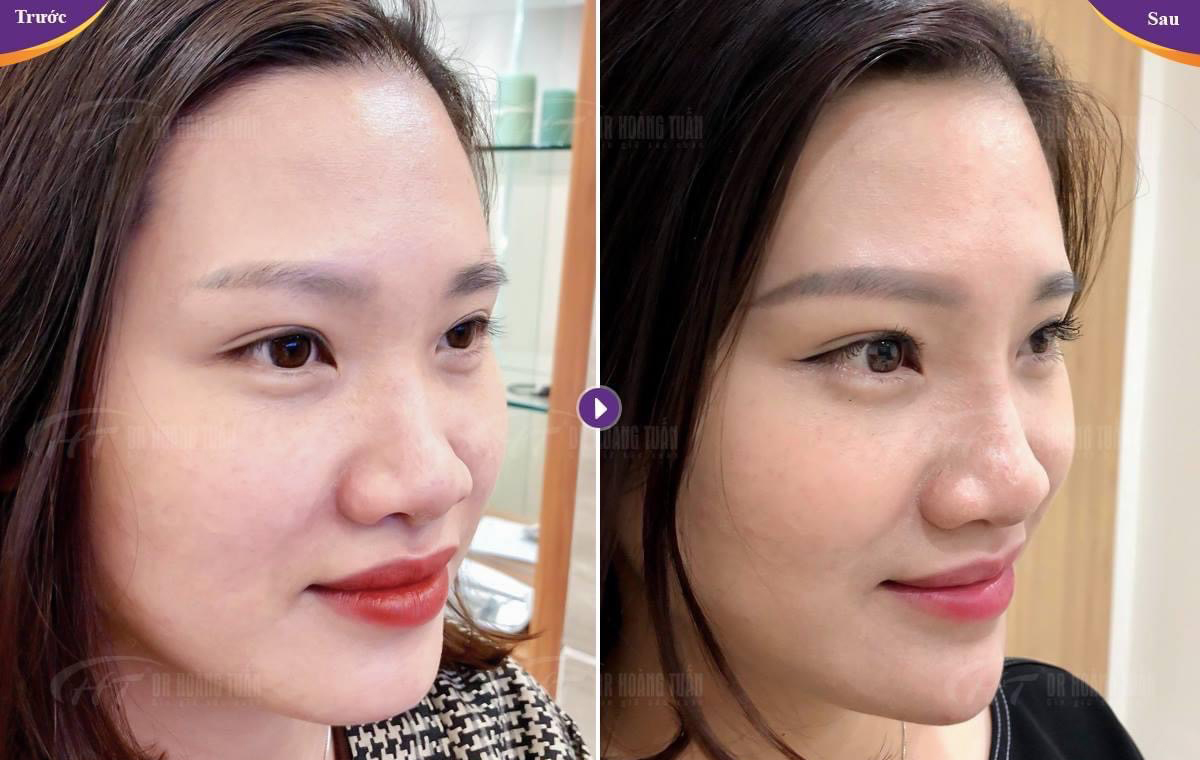 BS chuyên sản quyết định tiêm filler sau sinh để cải thiện diện mạo, ai gặp ngoài đời cũng phải xuýt xoa - Ảnh 2.