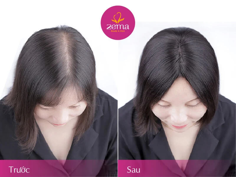 7 cách trị rụng tóc hiệu quả, giúp tóc dày mượt bồng bềnh - Ảnh 20.