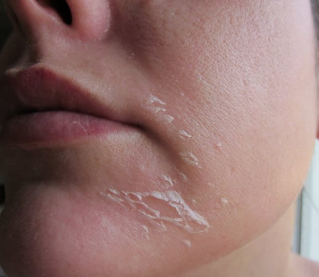 Peel da mùa hè để tăng sinh collagen: Chuyên gia khuyến cáo những lưu ý quan trọng - Ảnh 1. Peel da mùa hè để tăng sinh collagen: Chuyên gia khuyến cáo những lưu ý quan trọng - Ảnh 1.