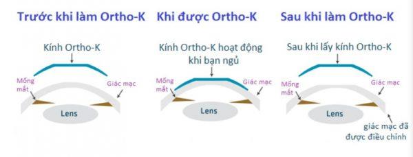 Không cần phẫu thuật mà vẫn có thể “tạm biệt kính cận” vào ban ngày nhờ làm một việc trong lúc ngủ - Ảnh 4. Không cần phẫu thuật mà vẫn có thể “tạm biệt kính cận” vào ban ngày nhờ làm một việc trong lúc ngủ - Ảnh 4.