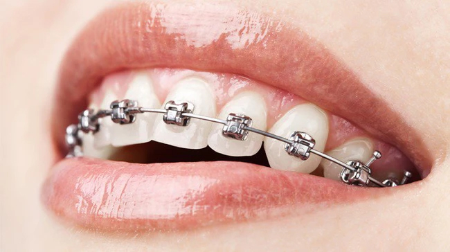 Niềng răng để răng đều hạt bắp, khuôn mặt cân đối bất ngờ: Có 5 kiểu cho bạn thỏa sức lựa chọn! - Ảnh 2.