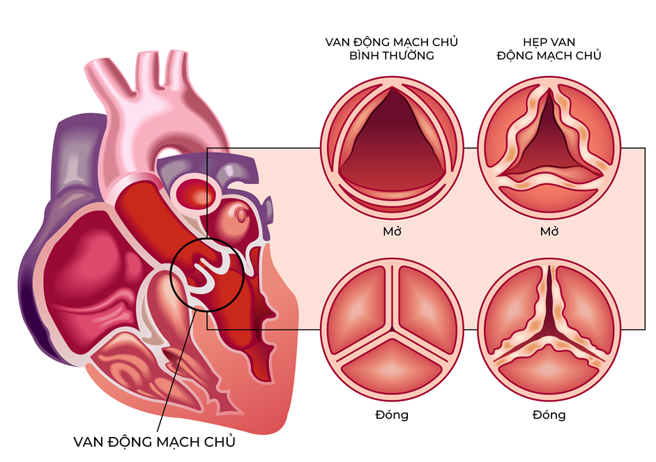 Ứng dụng cộng nghệ thay van động mạch chủ thế hệ mới trong điều trị các bệnh lý van tim phức tạp - Ảnh 1.