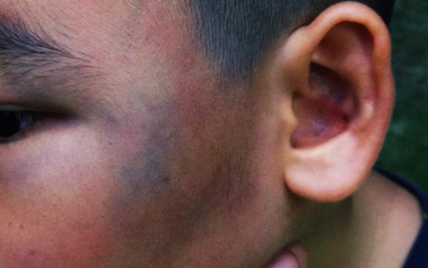 Xôn xao hình ảnh 1 bé trai bị hành hung dã man đến bầm tím mặt tại chung cư Sài Gòn
