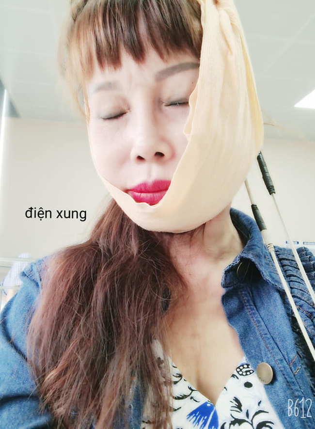 Cô dâu 63 tuổi than thở vì phải nhập viện trị méo miệng do di chứng sau phẫu thuật thẩm mỹ: "Bác sĩ nói để lâu là méo cả đời" - Ảnh 2.