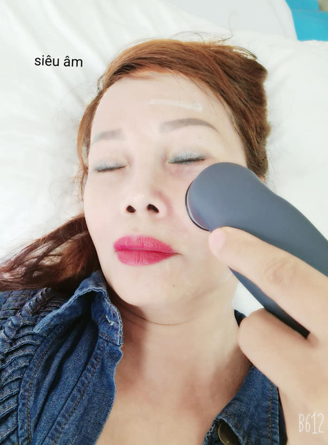 Cô dâu 63 tuổi than thở vì phải nhập viện trị méo miệng do di chứng sau phẫu thuật thẩm mỹ: "Bác sĩ nói để lâu là méo cả đời" - Ảnh 4.