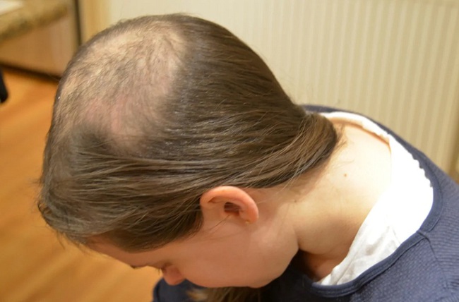 Cô gái phát điên vì nghiện nhổ tóc mỗi ngày, 15 tuổi đã hói cả đầu, hóa ra là mắc căn bệnh mà nữ giới và thanh thiếu niên chiếm tỷ lệ cao nhất - Ảnh 3.