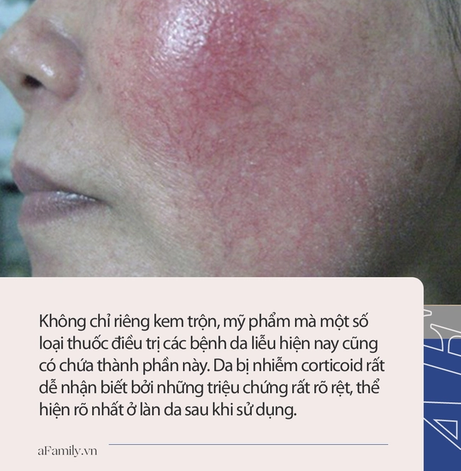 Da mặt bị nhiễm corticoid là làn da bị tổn thương nghiêm trọng, mài mòn, viêm nhiễm mãn tính: Nghe bác sĩ da liễu chỉ rõ nguyên nhân và cách điều trị - Ảnh 2.