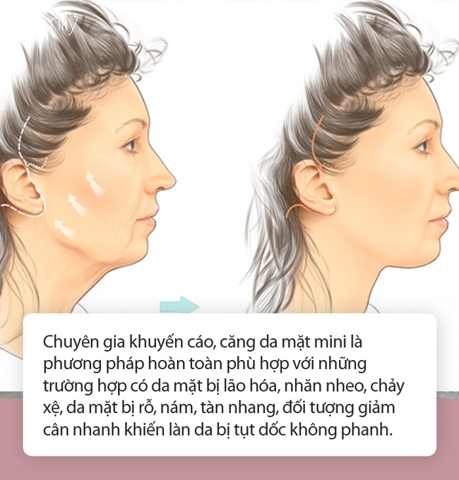 Căng da mặt mini - Cứu tinh cho chị em có làn da mới bị lão hóa, nhất là trường hợp giảm cân nhanh, đột ngột - Ảnh 3.