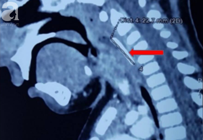 Tai nạn kinh hoàng: Bé trai 18 tháng tuổi đang ăn bị anh trai chạy tông vào người, bị chiếc nĩa đâm xuyên họng - Ảnh 1.