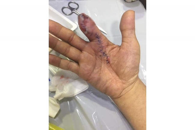 Chàng trai bị viêm hoại tử, phẫu thuật cắt bỏ một đốt ngón tay sau khi rửa tôm - Ảnh 2.