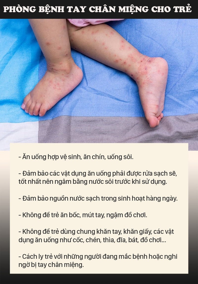 Bệnh tay chân miệng gia tăng, nhiều trẻ sốt cao không xác định nguồn lây, bố mẹ nên nhận diện bệnh để tránh nhầm lẫn với các bệnh ngoài da khác - Ảnh 4.