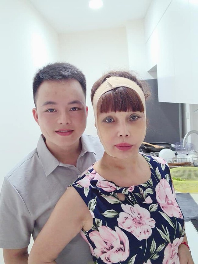 Sau nửa năm dao kéo, cô dâu 62 tuổi ở Cao Bằng vẫn sở hữu gương mặt cứng đơ, méo lệch - Ảnh 3.