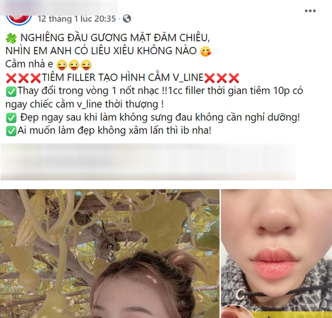 Mê tiêm filler tại spa rẻ tiền, chị em gặp biến chứng kinh hoàng và lời cảnh báo gan ruột từ chuyên gia - Ảnh 1.