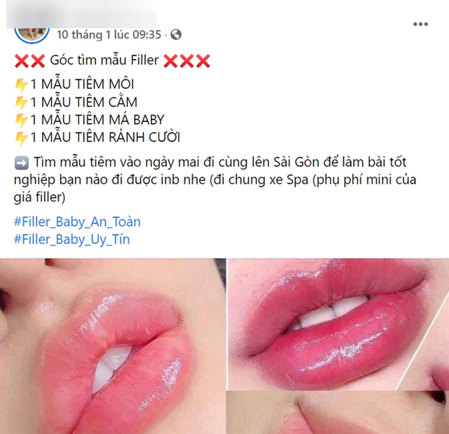 Mê tiêm filler tại spa rẻ tiền, chị em gặp biến chứng kinh hoàng và lời cảnh báo gan ruột từ chuyên gia - Ảnh 3.