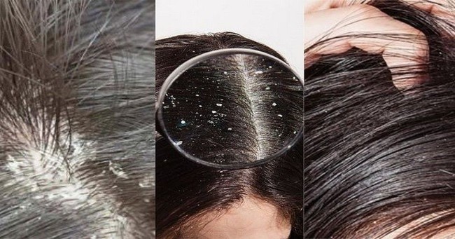 Giảm tình trạng bị gầu - Ảnh 2.