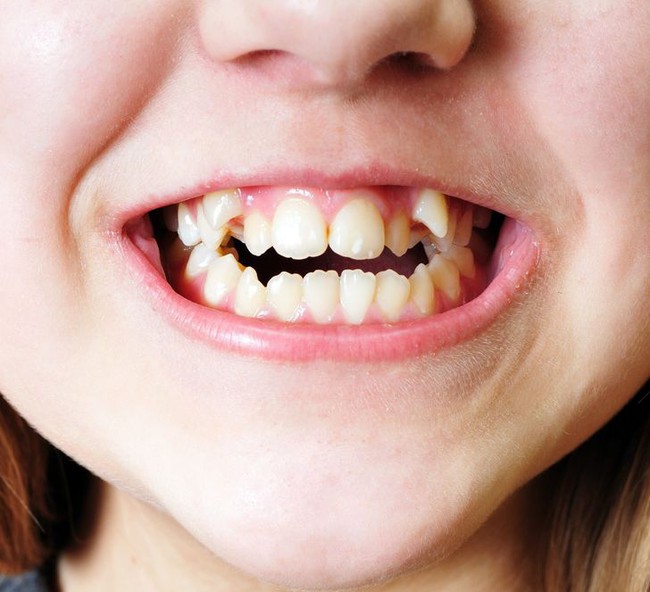 Đừng chủ quan khi thấy con há miệng trong lúc ngủ, bởi nó có thể khiến trẻ mắc phải một số vấn đề sức khỏe nghiêm trọng - Ảnh 3.