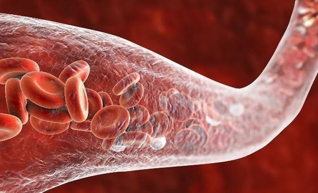 Nữ sinh 22 tuổi bị nhồi máu não đột ngột, thủ phạm gây bệnh là cô thường xuyên làm việc này sau khi quan hệ - Ảnh 2.