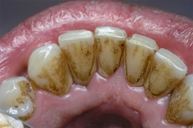 Có 4 dấu hiệu này ở miệng thì coi chừng cao răng đang "bành trướng", gây ê buốt lẫn hàng tá bệnh nha chu - Ảnh 1.