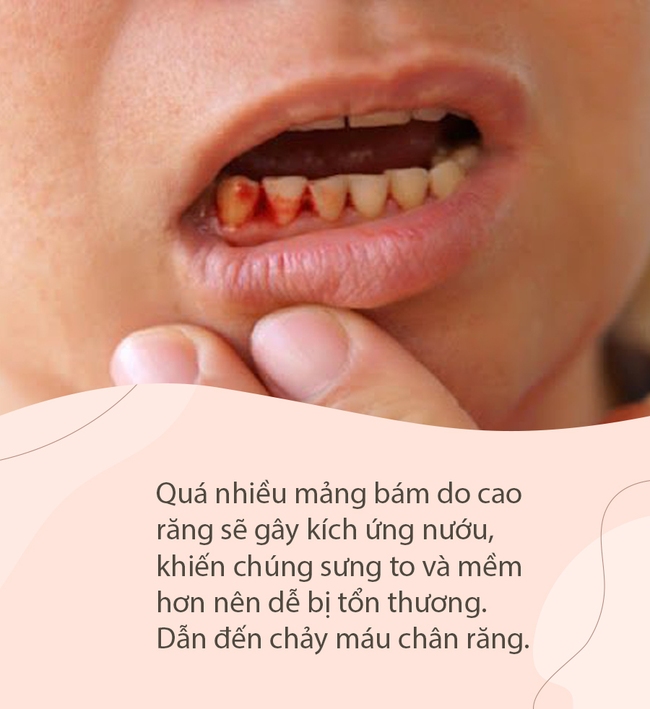 Có 4 dấu hiệu này ở miệng thì coi chừng cao răng đang "bành trướng", gây ê buốt lẫn hàng tá bệnh nha chu - Ảnh 3.