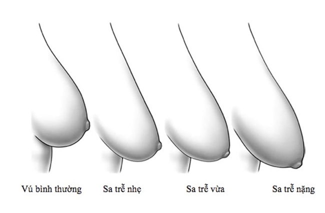 Tiến hành phẫu thuật thu gọn vú phì đại có cho con bú được không? - Ảnh 1.