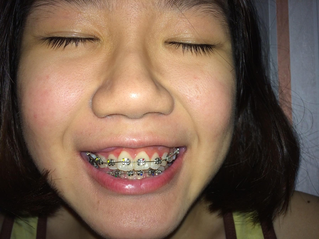 Cô gái năm xưa từng bị "xua đuổi" nay bỗng lột xác 360 độ nhờ 2 lần thẩm mỹ đơn giản, xinh đẹp vượt mong đợi khiến cả họ không nhận ra nổi - Ảnh 2.