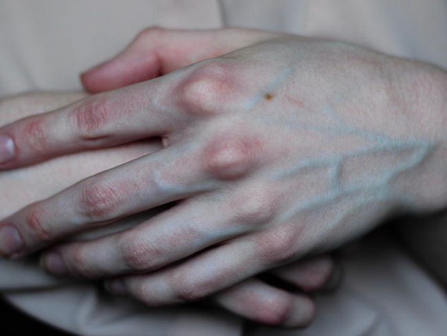 Có 4 dấu hiệu này xuất hiện trên bàn tay, cảnh báo mạch máu bị tắc nghẽn - Ảnh 3.