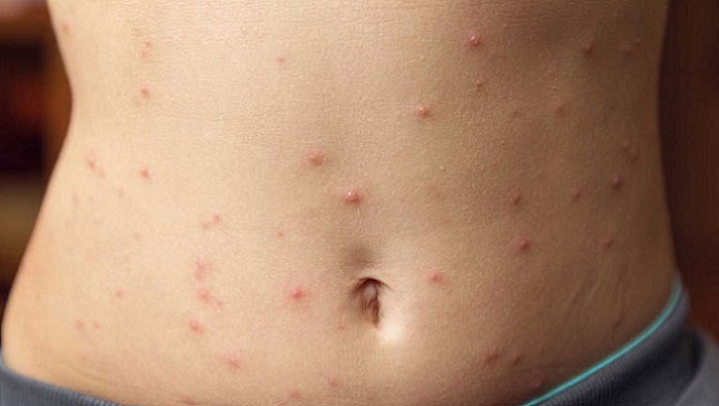 Lương y "bật mí" một loạt bài thuốc trị nóng trong người - Ảnh 1.