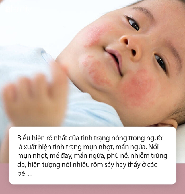 Lương y "bật mí" một loạt bài thuốc trị nóng trong người - Ảnh 5.