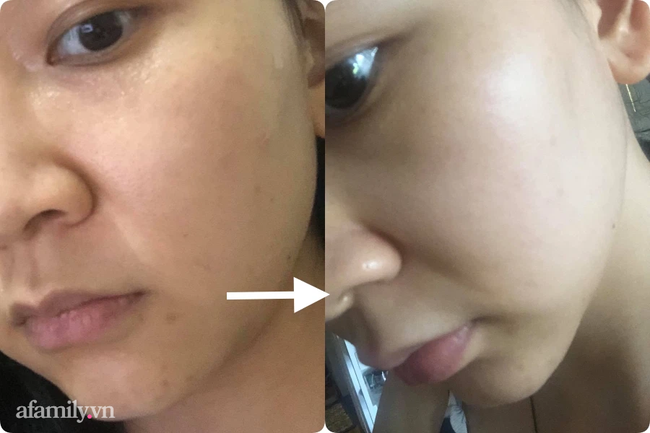 Tôi đã thoát khỏi tình trạng da xấu khủng khiếp chỉ sau 2 tuần dùng Retinal - Ảnh 6.