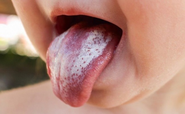 Tự nhìn lưỡi "chẩn bệnh": Có những dấu hiệu sau đồng nghĩa cơ thể đang bị ốm, cần khẩn trương đi khám - Ảnh 3.