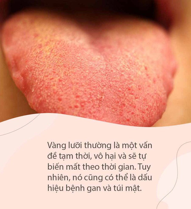 Tự nhìn lưỡi "chẩn bệnh": Có những dấu hiệu sau đồng nghĩa cơ thể đang bị ốm, cần khẩn trương đi khám - Ảnh 5.