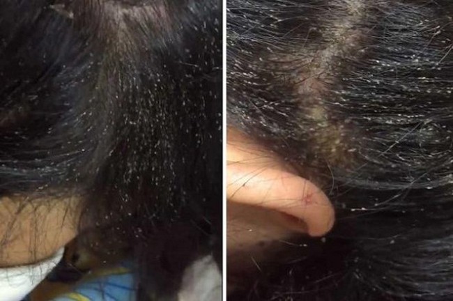 Rùng mình hàng ngàn con chấy "làm tổ" trên đầu cô gái trẻ, nhìn qua Tik Tok cũng thấy ngứa: Nghe lời cảnh báo của chuyên gia còn đáng sợ hơn - Ảnh 7.