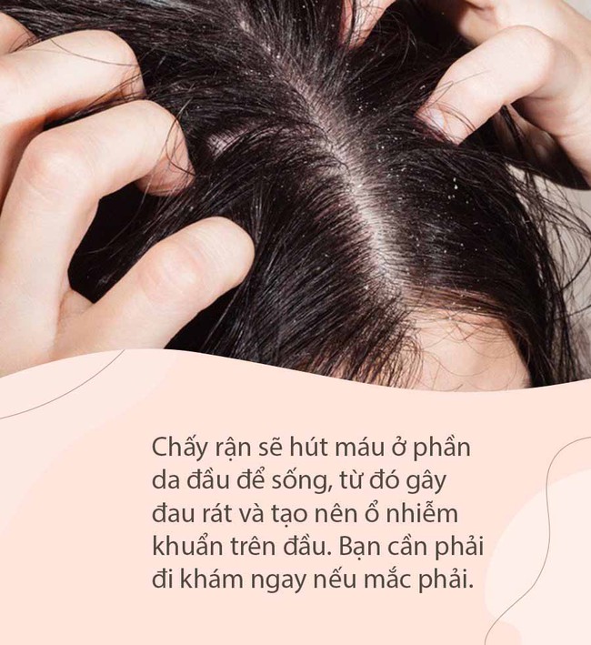 Rùng mình hàng ngàn con chấy "làm tổ" trên đầu cô gái trẻ, nhìn qua Tik Tok cũng thấy ngứa: Nghe lời cảnh báo của chuyên gia còn đáng sợ hơn - Ảnh 8.