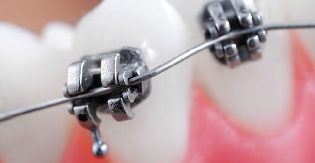 Nhiều người khổ sở vì niềng răng gặp phiền toái do dịch Covid-19, bác sĩ đưa ra lời khuyên khiến ai cũng thở phào! - Ảnh 1.