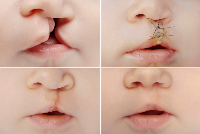 Phẫu thuật sứt môi, hở hàm ếch: Từ lưu ý đến giá cả, nơi nên thực hiện được chuyên gia chia sẻ tường tận - Ảnh 16.